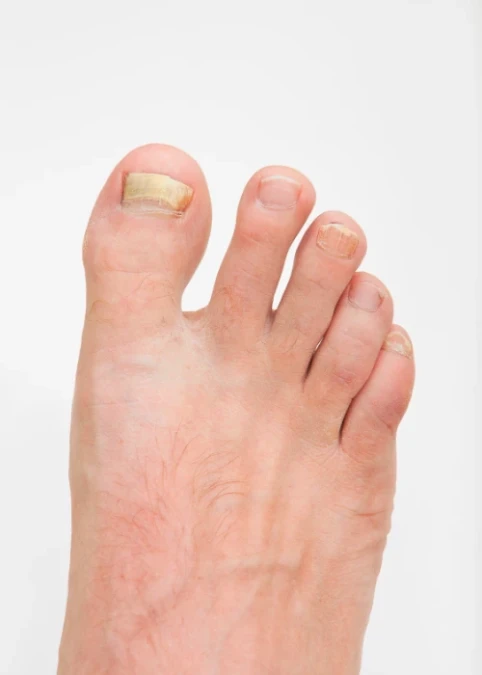 Onicomicose - Tratamento de Unhas com Micose